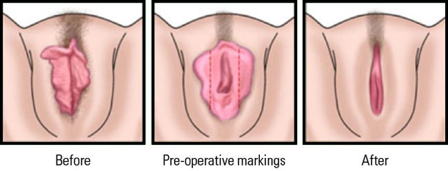 جراحی زیبایی واژن